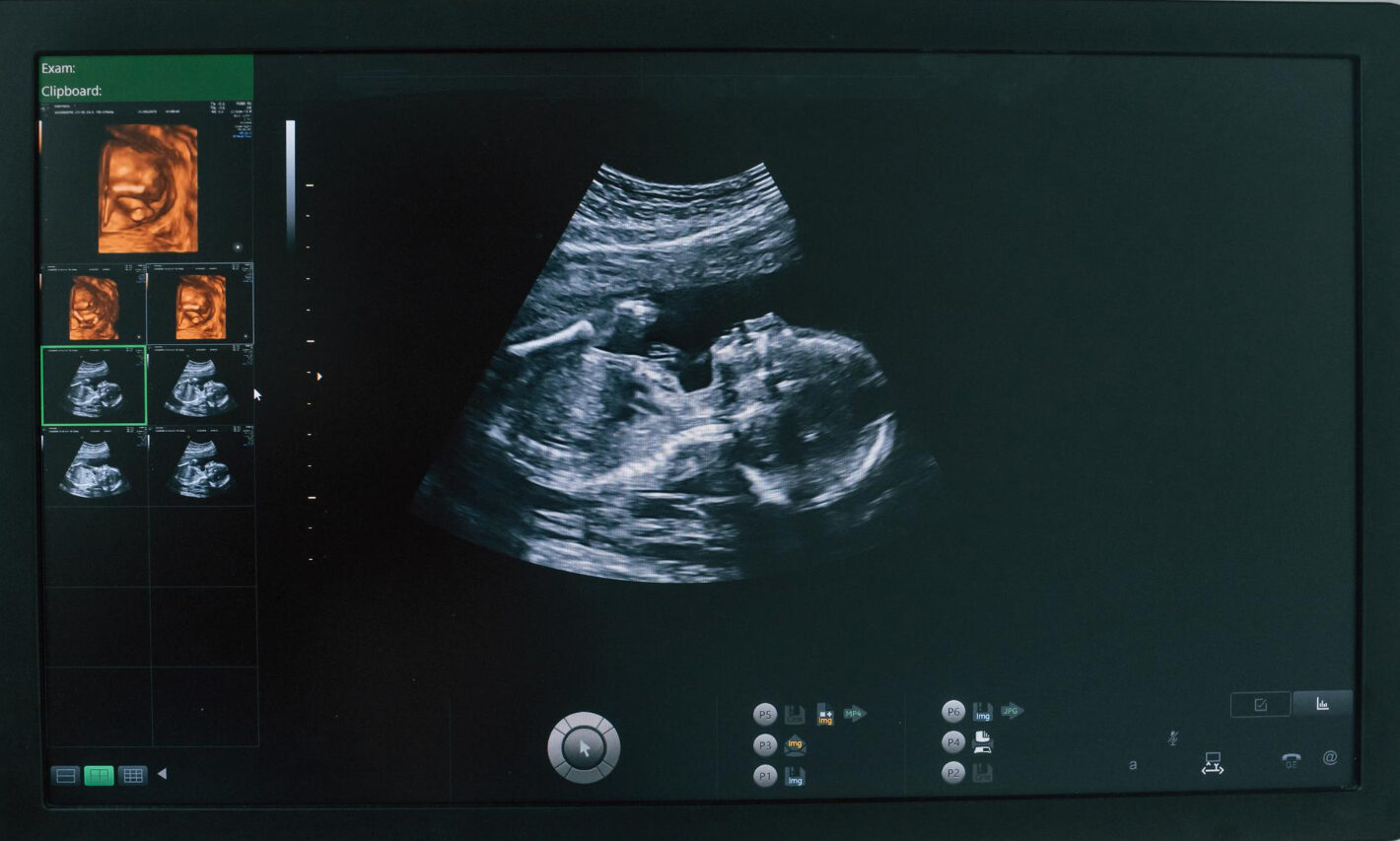Pediatric 2D echo
